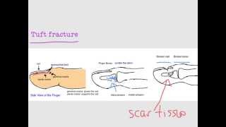 BoneTalks  FingerTip and Nailbed Injuries Tuft Fracture [upl. by Christie]