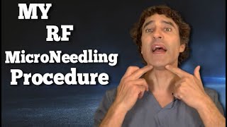 MY RF Microneedling RESULTS and EXPECTATIONS  Dr Rajani [upl. by Neelyt461]