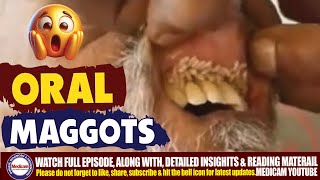 Shocking Maggots in the Mouth Oral Myiasis Causes Treatment and Prognosis 🦠🪰 [upl. by Shay]