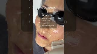 Erase Dark Spots Sun Spots amp Age Spots with IPL Photofacial [upl. by Bently188]