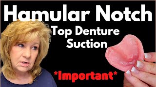 Top Denture Suction HAMULAR NOTCH Explained [upl. by Mandeville95]