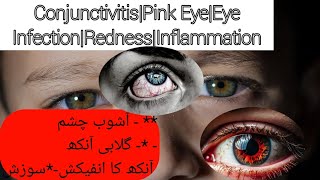 ConjunctivitisPink EyeEye InfectionRednessInflammationDr hafiz Abdul sattar anjumUrduHindi [upl. by Maribel759]