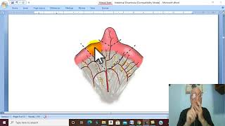 Intestinal Disorders in Arabic 7  Meckels Diverticulum   by Dr Wahdan [upl. by Nannahs602]