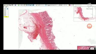 Cholecystitis  Histopathology slides [upl. by Hannad821]