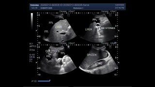 Ultrasound Video showing the Cirrhosis of the liver [upl. by Ardua]