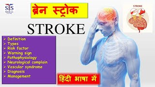 what is stroke full video in Hindi explore stroke brain braintest ischemicstroke [upl. by Willette]