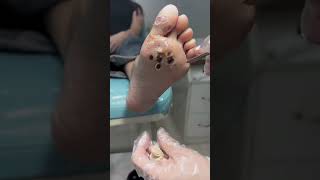 Treatment Callus and Dead skin Ep13  Sheng Clinic [upl. by Teuton]