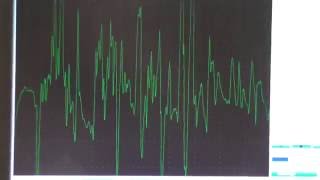 Myopathy EMG changes explained [upl. by Natsrik869]