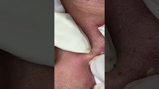 Big Cystic Acne Blackheads Extraction Blackheads amp Milia Whiteheads Removal Pimple Popping shorts [upl. by Eiggam]