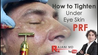 How to Tighten and Brighten the Under EyeDr Rajani Style Aesthetics Portland [upl. by Comstock]