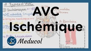 AVC ischémique causes embolie cérébrale AVC thrombose et AVC jonctionnel [upl. by Micro]