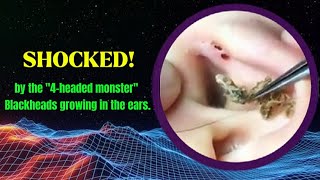 Shocked by the quot4headed monsterquot  Blackheads growing in the ears [upl. by Selinda]