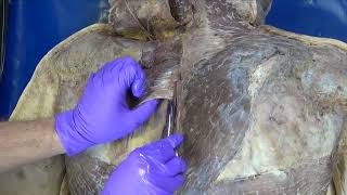 From Grant’s Dissection Video Collection Superficial Muscles of the Back [upl. by Gnas219]