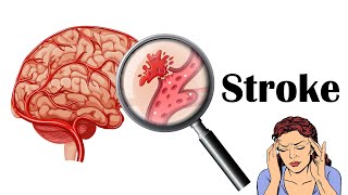 Stroke  Types Causes Risk Factors Signs amp Symptoms [upl. by Leval]