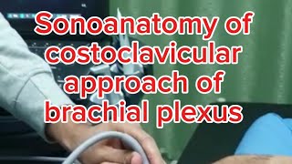 Sonoanatomy of costoclavicular approach of the brachial plexus [upl. by Gaspar]