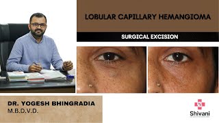 LOBULAR CAPILLARY HAEMANGIOMA  SURGICAL EXCISION  DR YOGESH BHINGRADIA [upl. by Ahsienat]