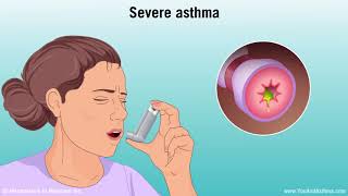 Understanding Asthma Mild Moderate and Severe [upl. by Draude726]