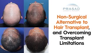 How a NonSurgical Hair Transplant Alternative can Overcome Limitations of Hair Transplants [upl. by Azirb]