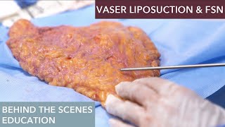 The Science Behind Vaser Liposuction How Does It Work [upl. by Fanni471]