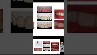 Charlamos con Eder Ramírez sobre Ceramco 3 Dentsplyprotesistadentalodontologiamoderna dentist [upl. by Lemal77]