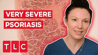 The Most Severe Case Of Psoriasis Dr Emma Has Ever Seen  The Bad Skin Clinic [upl. by Haimrej]