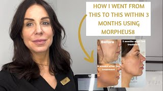 Is Morpheus8 worth it Before amp After of Morpheus8 Radiofrequency amp Microneedling Review [upl. by Eannej]