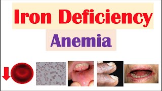 IronDeficiency Anemia Overview  Causes Pathophysiology Signs amp Symptoms Diagnosis Treatment [upl. by Loats]