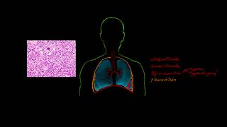 Respiratorisk svikt 13 Pneumoni [upl. by Frederiksen3]