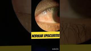 Nodular Episcleritis nodularepiscleritis eyediseases [upl. by Bernstein]