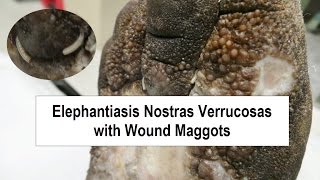 Elephantiasis Nostras Verrucosas and Wound Maggots [upl. by Ahselrac]