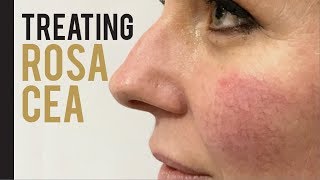 How this Make Up Artist Got Rid of Her Rosacea [upl. by Lori]