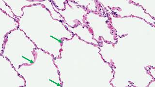 Histology of the lung explained by a pulmonary pathologist part 1 [upl. by Sokim]