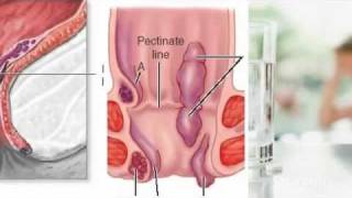 External Hemorrhoids Treatment [upl. by Norej]