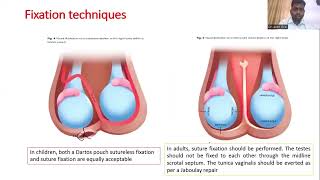 Testicular Torsion  Guidelines on management of Testicular torsion FRCS Urology Course [upl. by Delores]