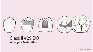 Class II amalgam restoration  My Dental Key [upl. by Rawden304]