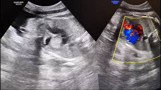 Intracardiac Tumor in fetus during pregnancy 37 weeks Rhabdomyoma [upl. by Rochella]