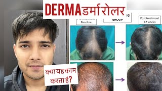 डर्मा रोलरDermaroller RESULT Dermaroller For Hair growth Side effects Hairfall Hairloss Hindi [upl. by Annawak]