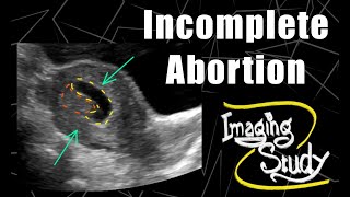 Incomplete Abortion  RPOC  Ultrasound  Case 166 [upl. by Kimmel]