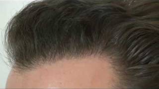 Haartransplantation Hattingen Hair Transplant  3089 FU´s [upl. by Turpin]