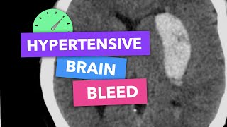 Hypertensive brain bleed  Radiopaedias Emergency Radiology Course [upl. by Haymes]