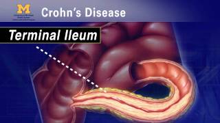 IBD School 102  What is Crohns Disease [upl. by Nelleh877]