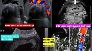 lecture 13 amniotic fluid ultrasound [upl. by Eelyek]