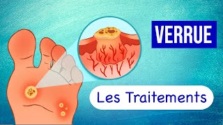 Verrues  Les Traitements pour les Soigner [upl. by Beall489]