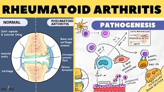 Rheumatoid Arthritis Pathophysiology  Rheumatoid Arthritis Pathogenesis  Arthritis pathophysiology [upl. by Sulrac385]