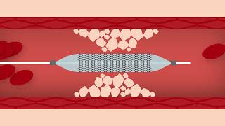 Heart Stent Procedure [upl. by Sido]