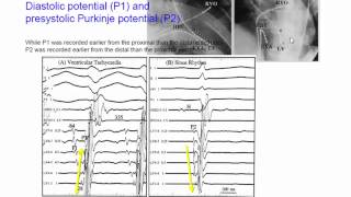 Fascicular VT [upl. by Spada]