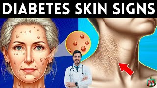 8 Skin Signs of Diabetes You Should Never Ignore [upl. by Nuhsed]