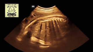 unilateral renal agenesis fetal ultrasound with contralateral lying down adrenal sign [upl. by Nylak]