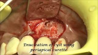 Periapical cyst removal and apicectomy in relation to 21 [upl. by Saihtam]