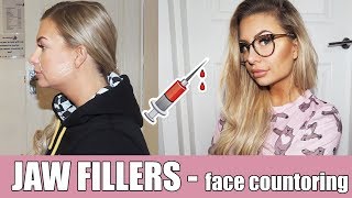 JAW FILLERS  Cheekbone jaw and smile line filler  Flawless Cosmetics  VLOG [upl. by Ahtnamys]